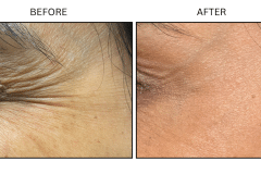 LB Neurotx Relx Crows Feet - Patient1