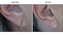 LB Fillers Earlobes - Patient1a