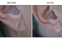 LB Fillers Earlobes - Patient1a