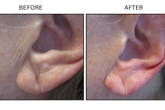 LB Fillers Earlobes - Patient1b