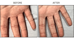 LB Medical Eczema - Patient2