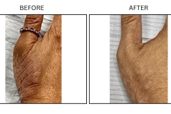 LB Medical Eczema - Patient1