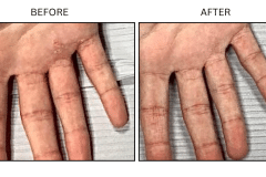 LB Medical Eczema - Patient2
