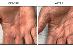 LB Medical Eczema - Patient3