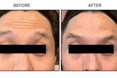 LB Neurotx Relx Forehead - Patient1