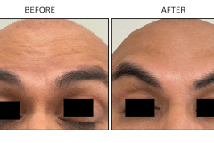 LB Neurotx Relx Forehead - Patient11