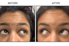 LB Neurotx Relx Forehead - Patient12