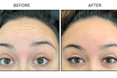 LB Neurotx Relx Forehead - Patient13