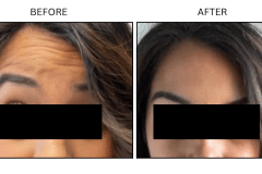 LB Neurotx Relx Forehead - Patient14