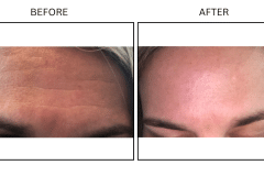 LB Neurotx Relx Forehead - Patient14