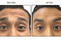 LB Neurotx Relx Forehead - Patient2