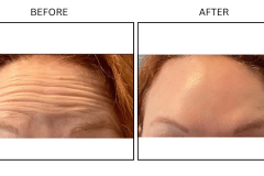LB Neurotx Relx Forehead - Patient4