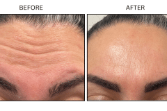 LB Neurotx Relx Forehead - Patient5