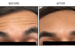 LB Neurotx Relx Forehead - Patient9