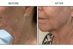 Lasers Fraxel - Patient1b