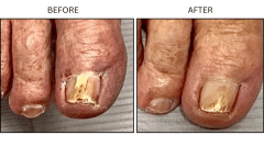 LB Medical Fungus - Patient2