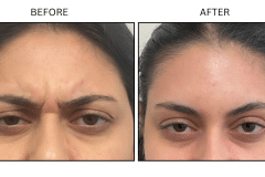 LB Neurotx Relx Glabellar Frown Lines - Patient1
