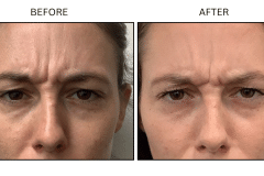 LB Neurotx Relx Glabellar Frown Lines - Patient10