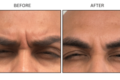 LB Neurotx Relx Glabellar Frown Lines - Patient6