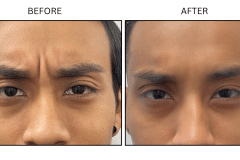 LB Neurotx Relx Glabellar Frown Lines - Patient9