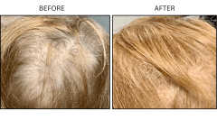 LB Medical Hair Loss - Patient5