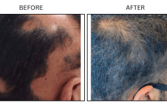 LB Medical Hair Loss - Patient10
