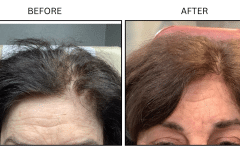 LB Medical Hair Loss - Patient1a