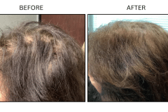 LB Medical Hair Loss - Patient1b