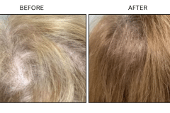 LB Medical Hair Loss - Patient2