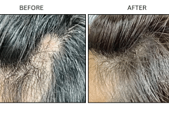 LB Medical Hair Loss - Patient3