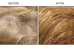 LB Medical Hair Loss - Patient4a