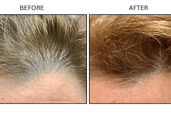 LB Medical Hair Loss - Patient4b