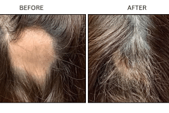 LB Medical Hair Loss - Patient6