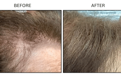 LB Medical Hair Loss - Patient7