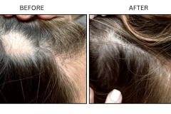 LB Medical Hair Loss - Patient9