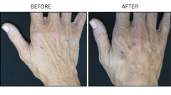 LB Fillers Hands - Patient2b