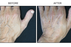 LB Fillers Hands - Patient2a