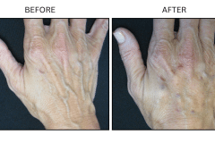 LB Fillers Hands - Patient2b