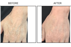 Lasers IPL - Patient1