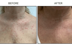 Lasers IPL - Patient2b