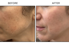 Lasers IPL - Patient3a