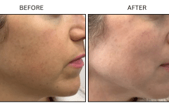 LB Lasers IPL - Patient3b