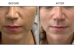 Lasers IPL - Patient3c