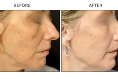 Lasers IPL - Patient4a