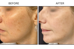 Lasers IPL - Patient4b