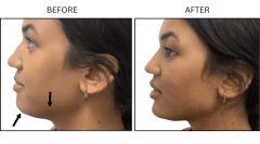 LB Fillers Jawline - Patient1