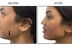LB Fillers Jawline - Patient1