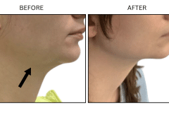 LB Fillers Jawline - Patient2