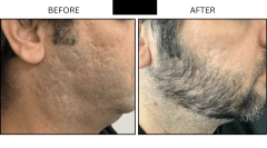 LB Lasers Laser Resurfacing Co2 Laser - Patient13