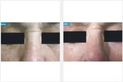 01Laser-Resurfacing